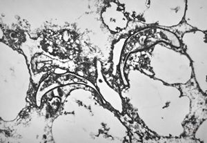 M,50y. | Pneumocystis carinii - lung M,50y. | Pneumocystis carinii - lung